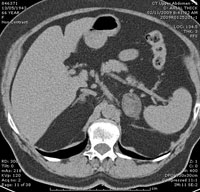 Adrenal Photo Gallery