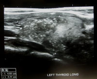 Thyroid Photo Gallery