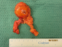 Adrenal Photo Gallery