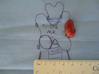 Parathyroid Photo Gallery