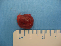 Parathyroid Photo Gallery