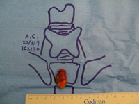 Parathyroid Photo Gallery