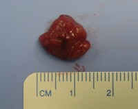 Parathyroid Photo Gallery