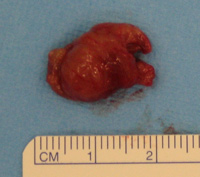 Parathyroid Photo Gallery