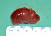 Parathyroid Photo Gallery