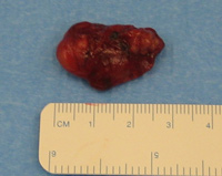 Parathyroid Photo Gallery