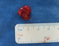 Parathyroid Photo Gallery