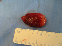 Parathyroid Photo Gallery