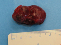 Parathyroid Photo Gallery