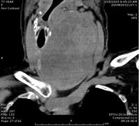 Thyroid Photo Gallery