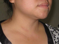 Thyroid Photo Gallery