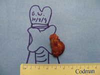 Parathyroid Photo Gallery