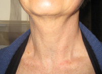 Parathyroid Photo Gallery