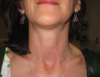 Parathyroid Photo Gallery