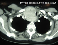 Thyroid Photo Gallery