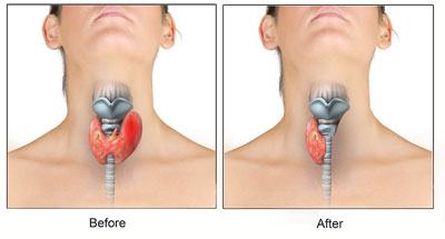 Thyroid Surgery